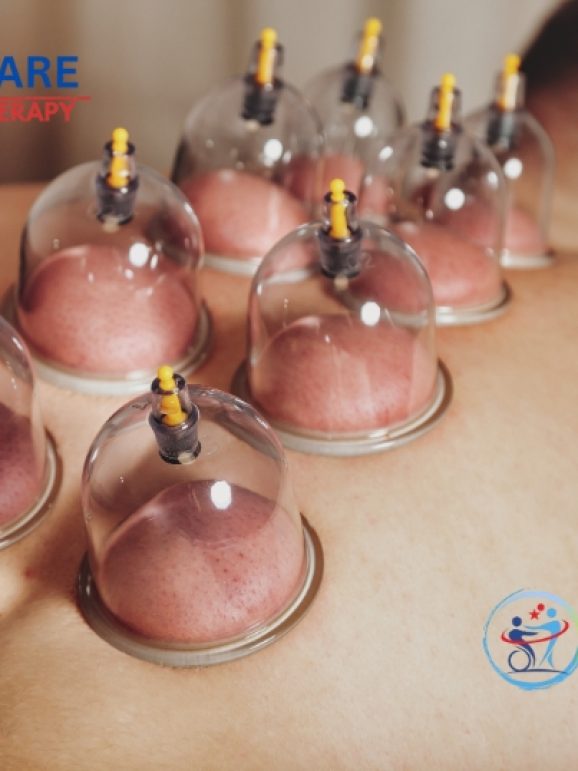 Cupping Therapy At Home