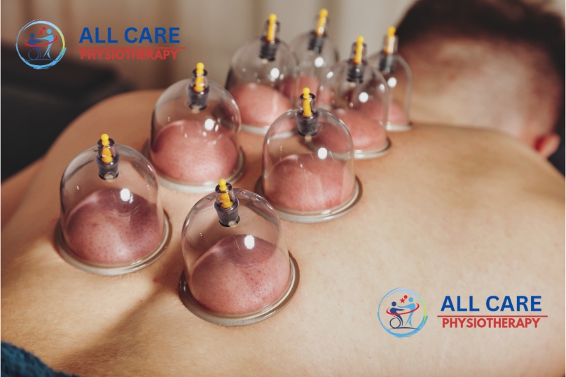 Cupping Therapy At Home