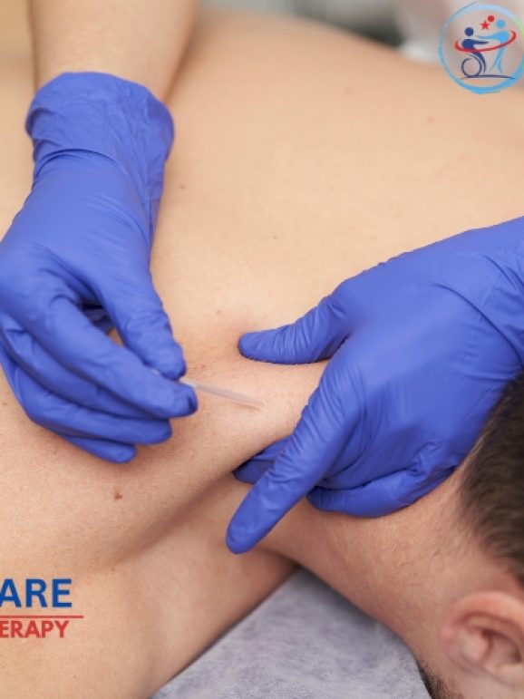 Dry Needling Therapy At Home