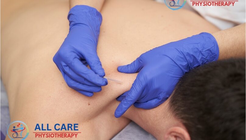 Dry Needling Therapy At Home