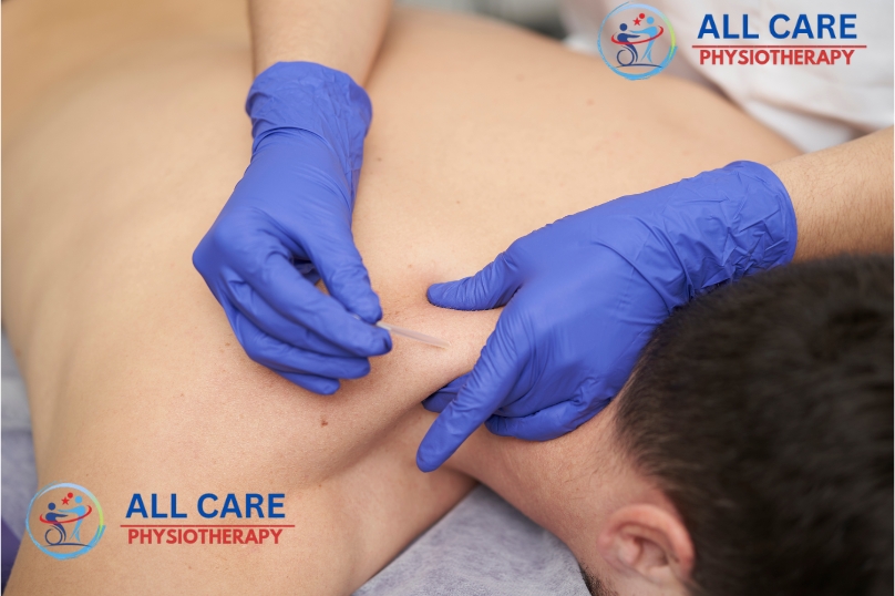 Dry Needling Therapy At Home Dry Needling Therapy At Home